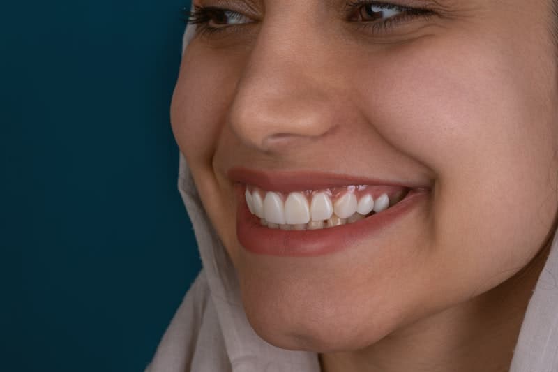 Faccette Dentali